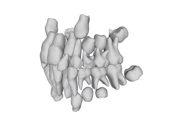 All fused teeth with CBCT fallback