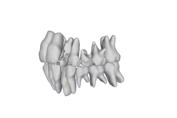 All fused teeth without fallback