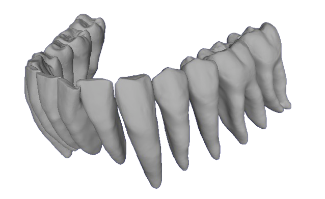 Lower fused teeth